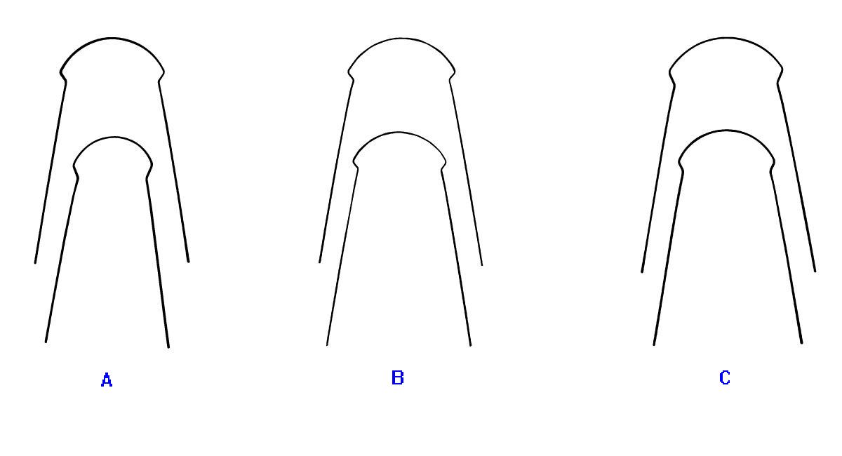 Lingual Archwires