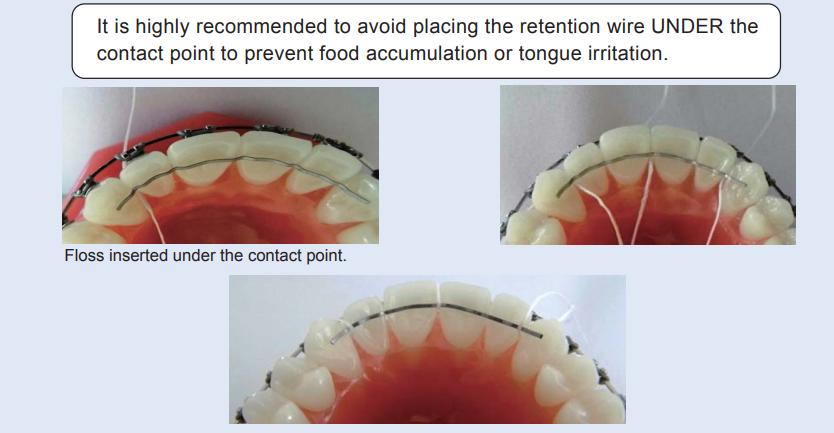 retainer-n2