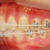 tooth-1